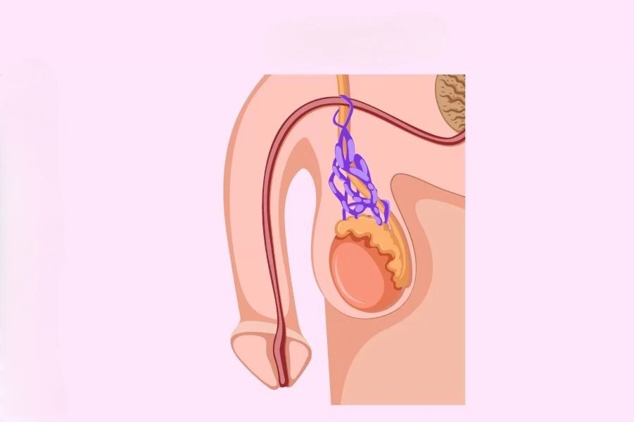 دوالي-الخصية